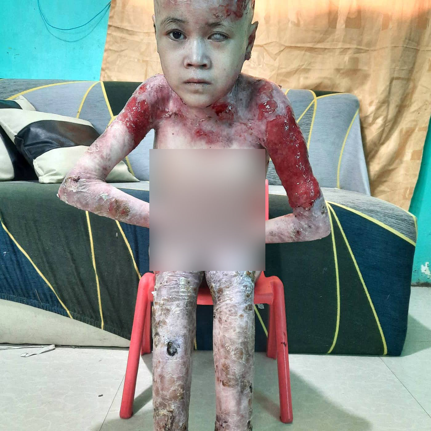 Ashley with 80% skin loss and extensive scarring from EB disease