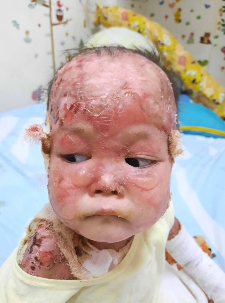Lily's Fragile Skin on Face