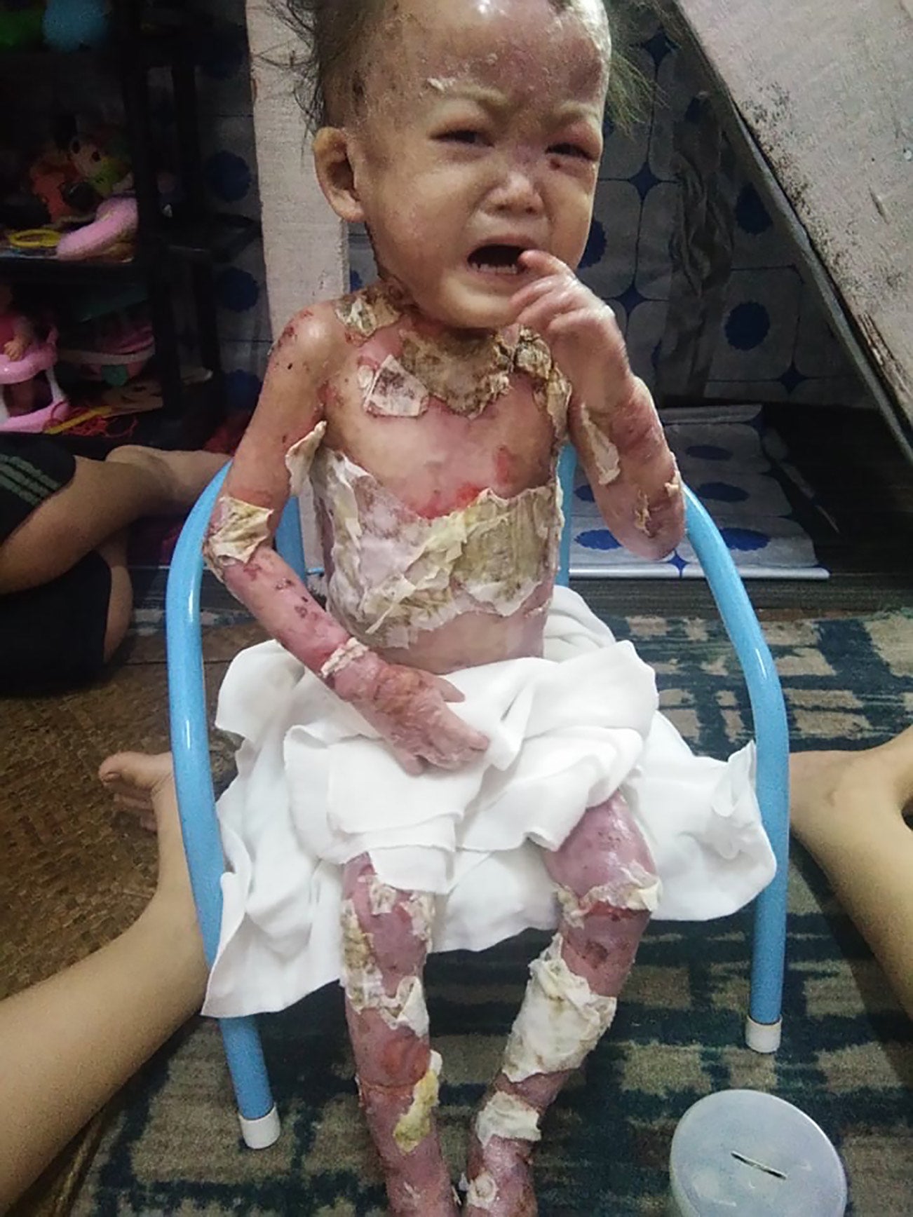 Baby Lily before clean bandages